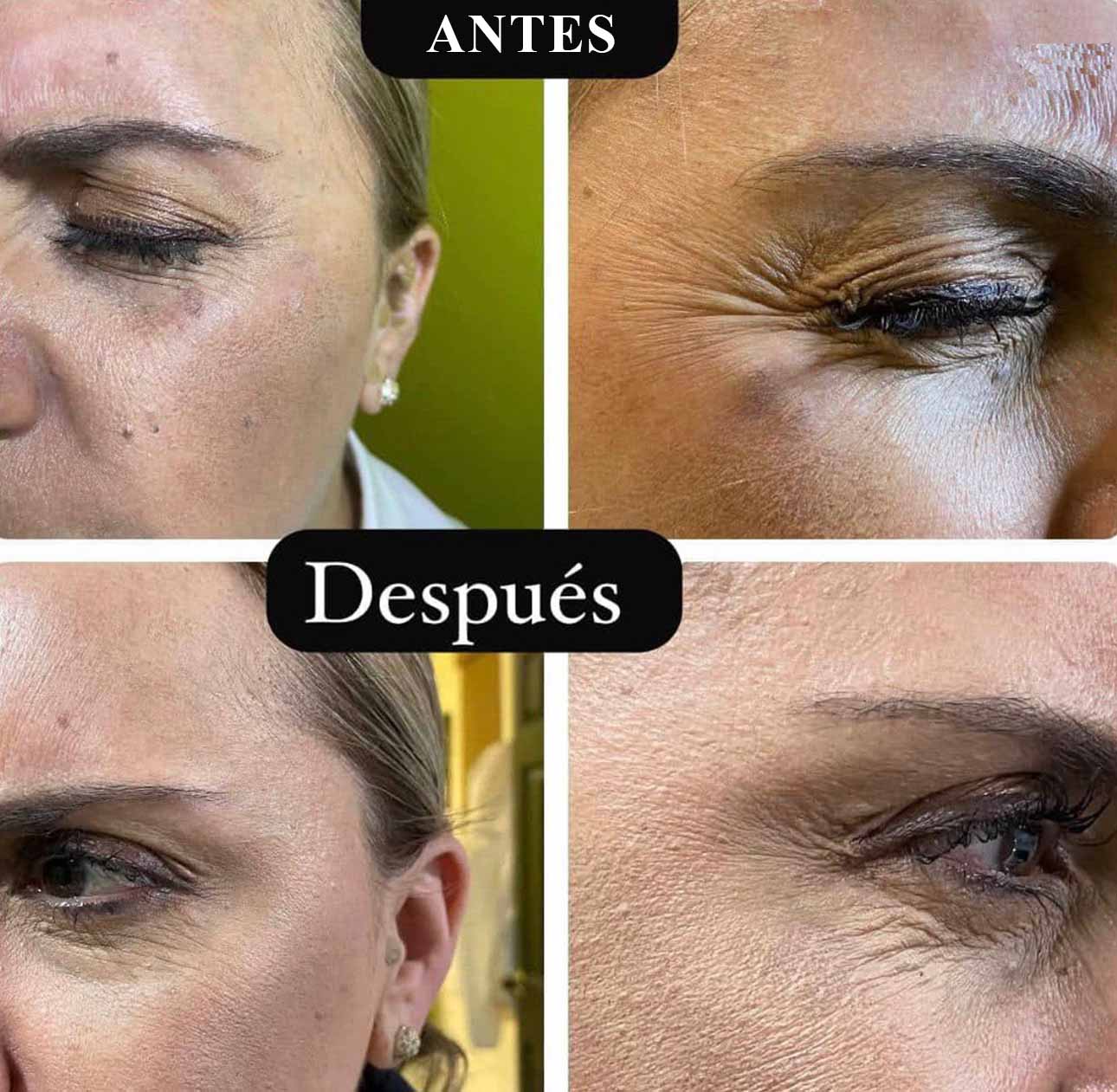 botox1
