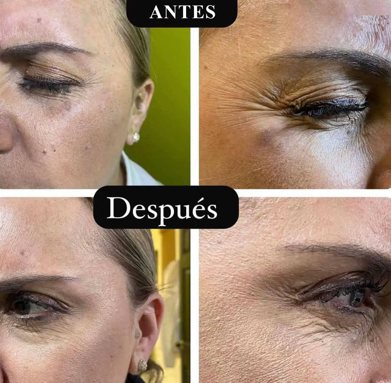 botox1