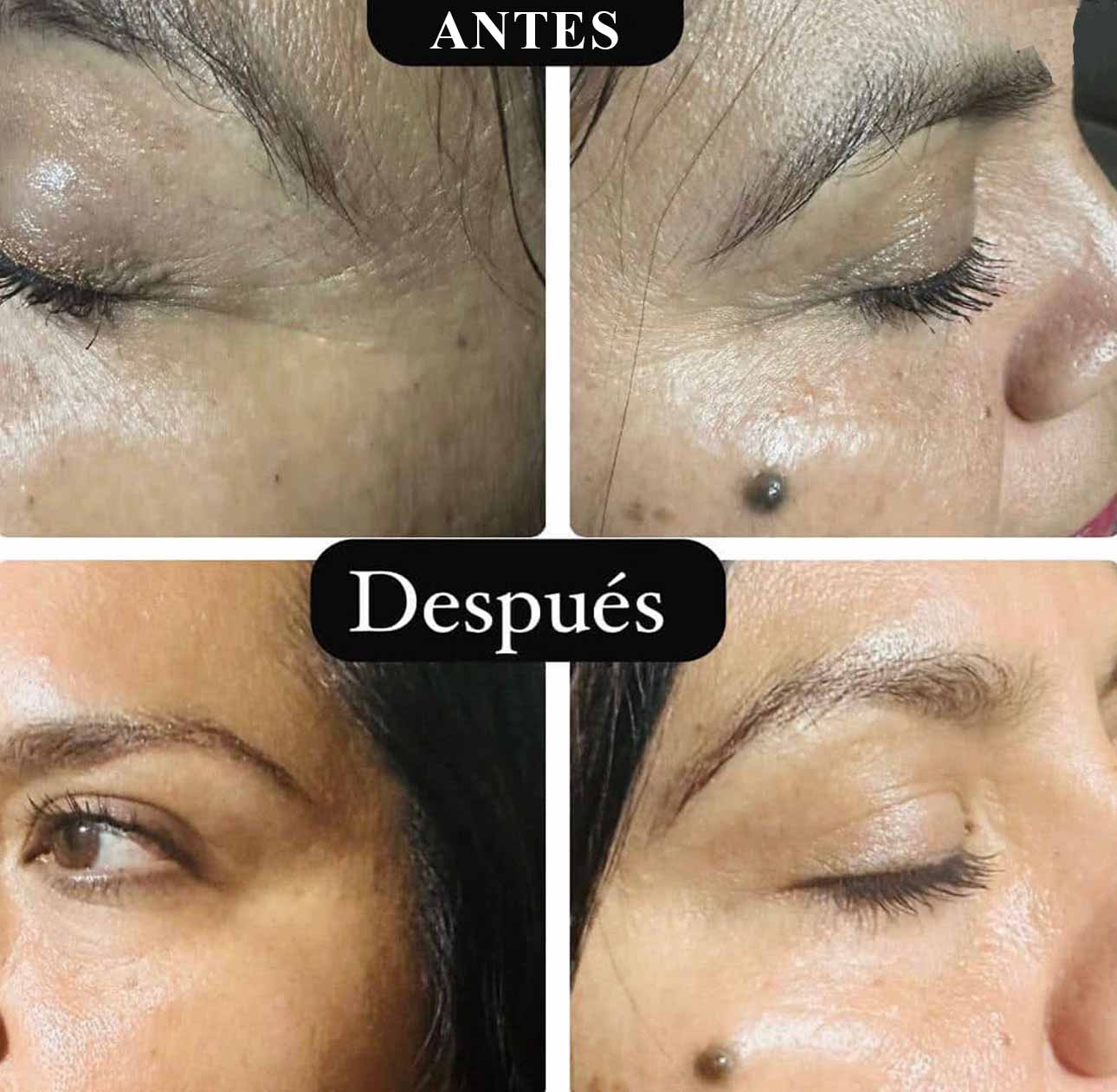 botox2