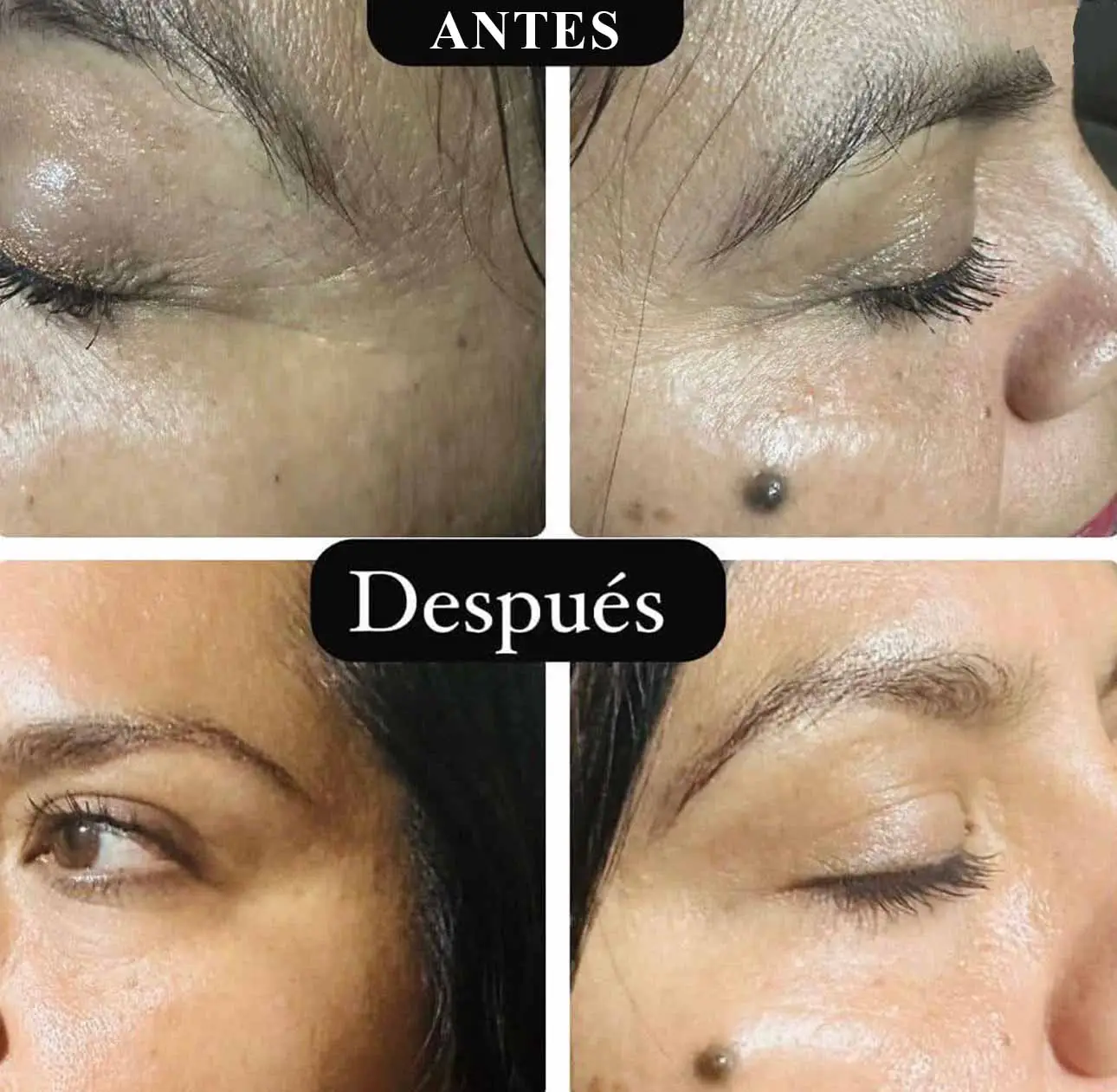 botox2