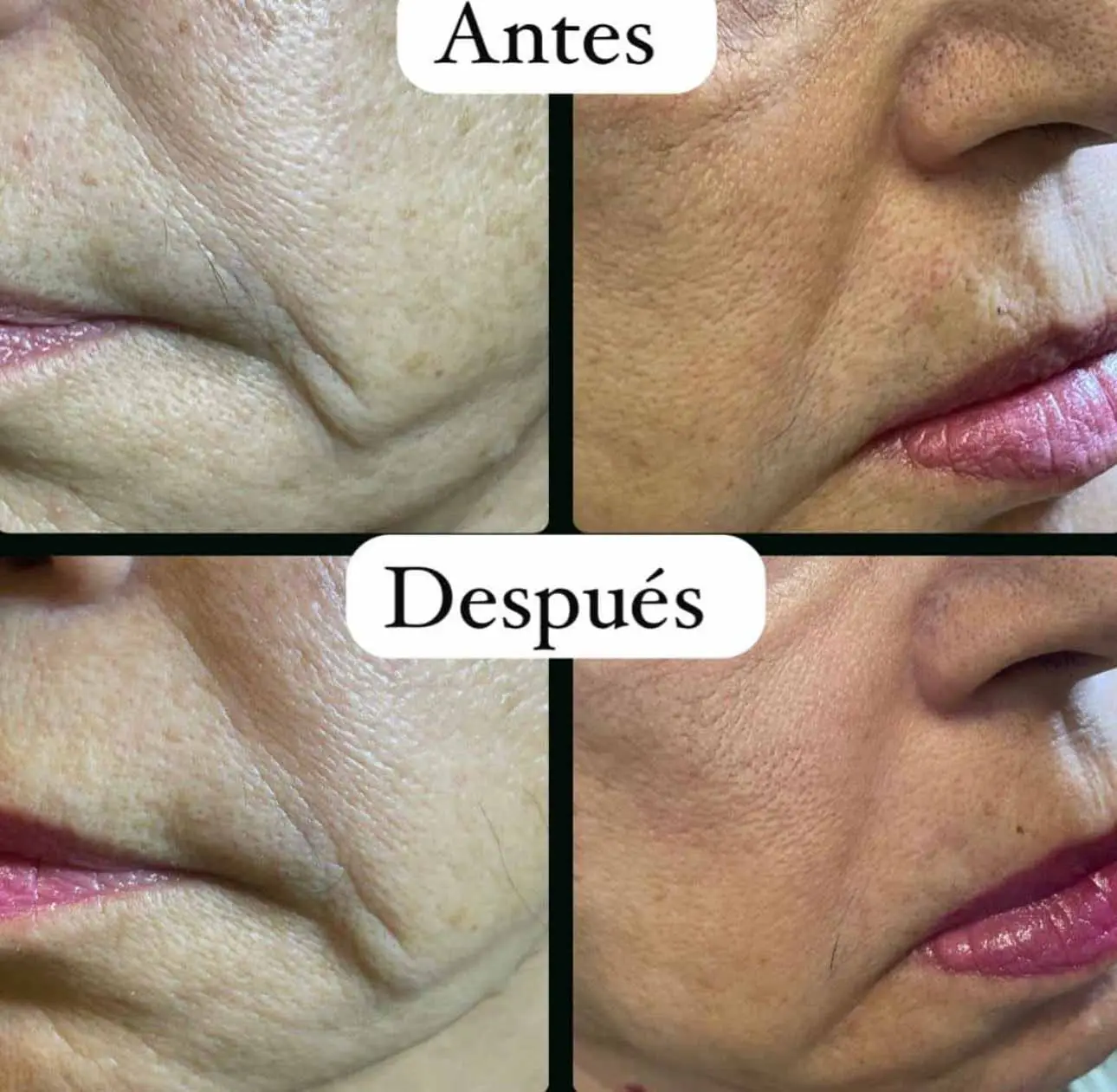 botox3